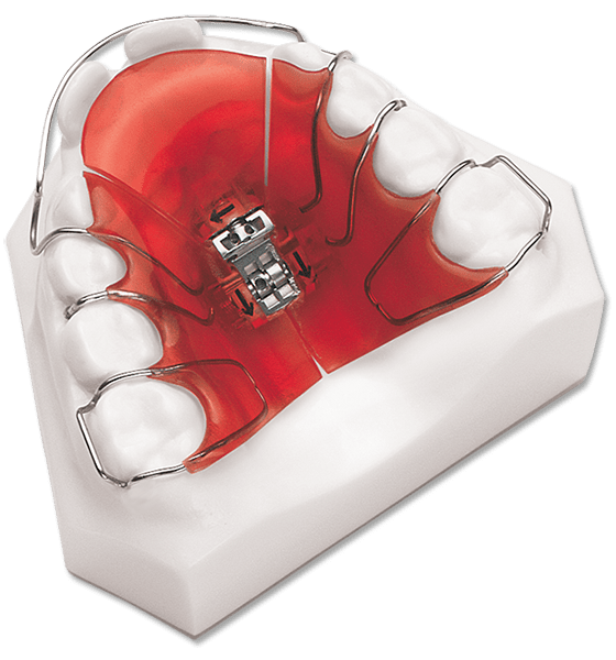 Removable Orthodontic Appliances - DynaFlex