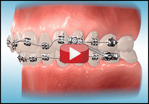 Cs System Class Ii And Class Iii Corrector Dynaflex 5206